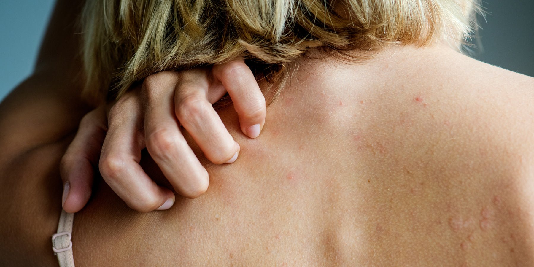 Wat is een zonneallergie? - Happlify